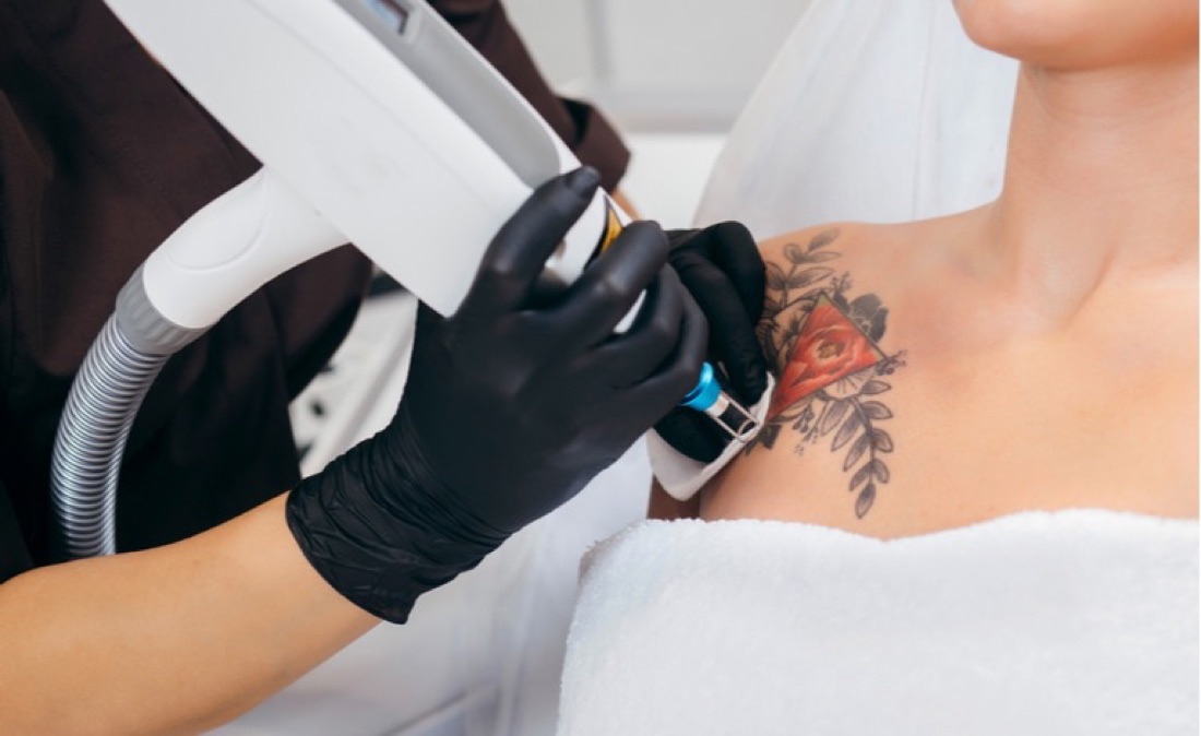 Remoção de Tatuagem — Clínica Carina Borges