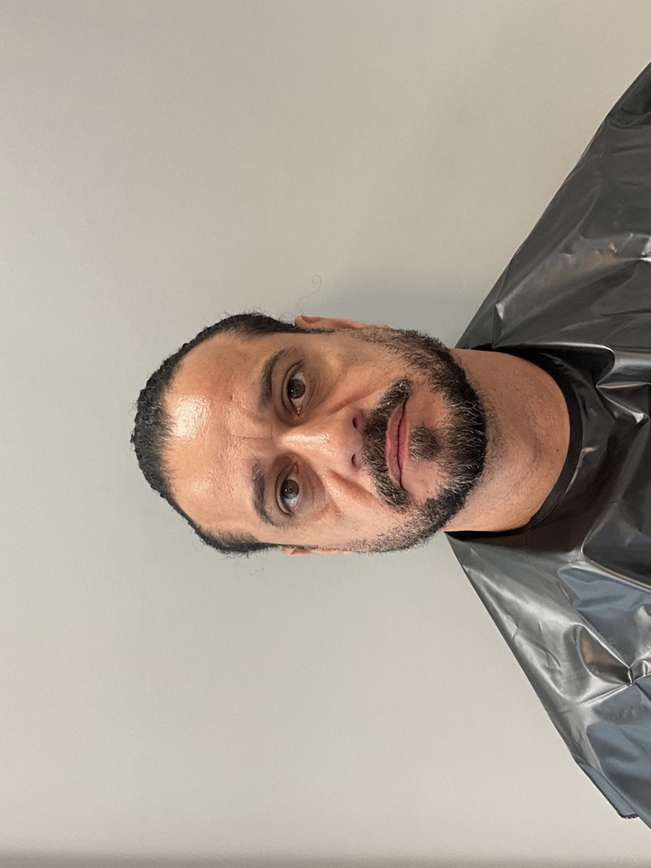 Harmonização Facial Masculina — antes