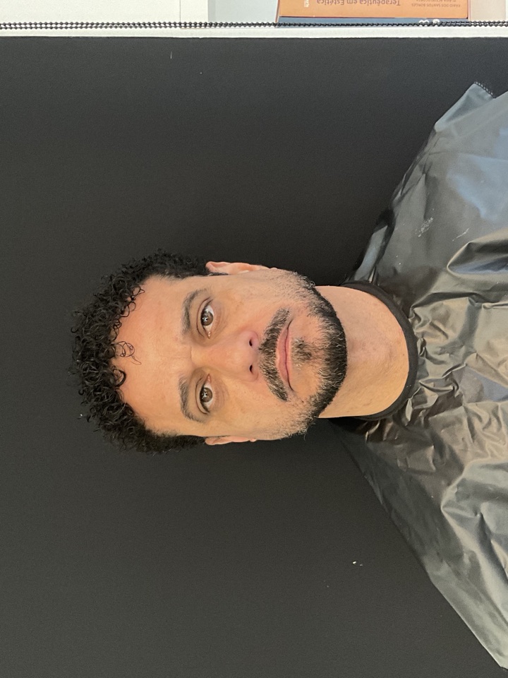 Harmonização Facial Masculina — depois