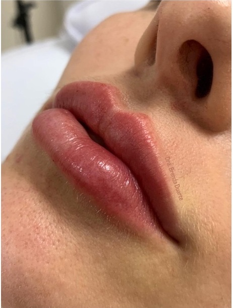 Preenchimento Labial — depois