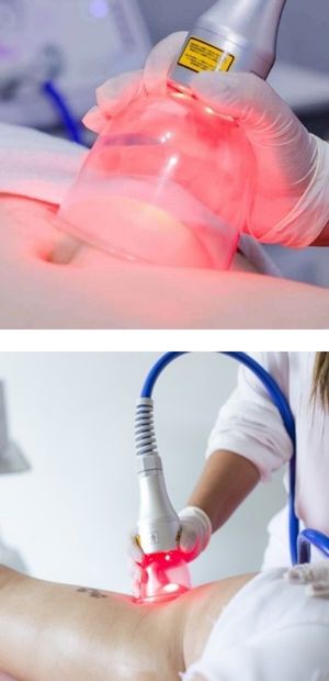Vácuo laser (endermologia)