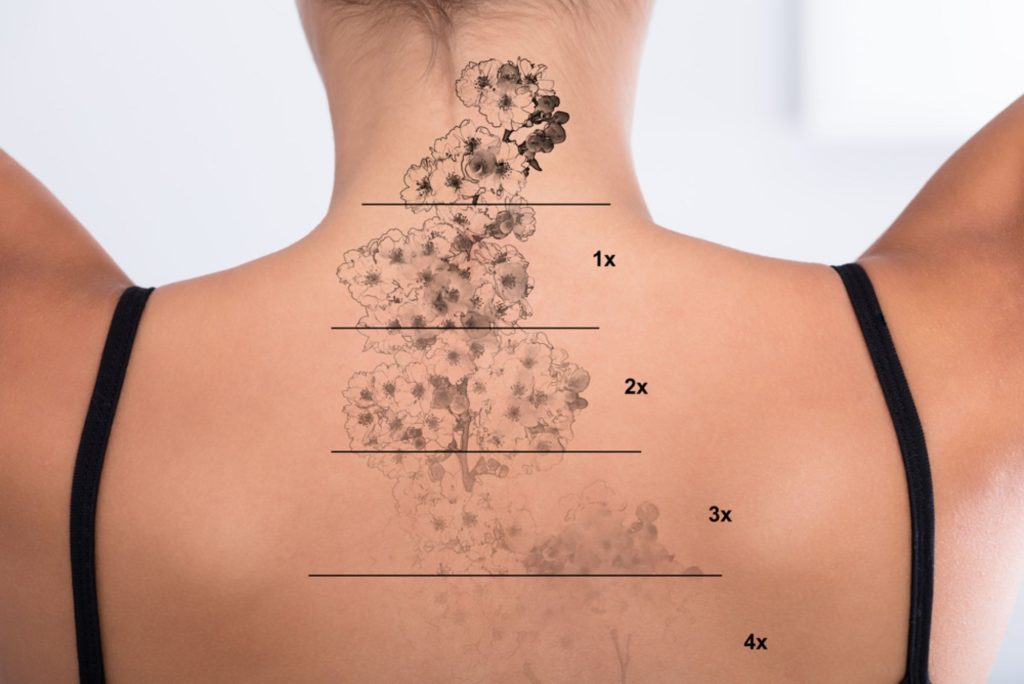 Remoção de tatuagem